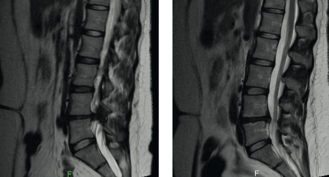 hernia-voor-en-na