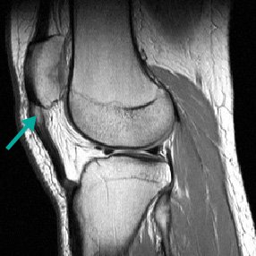 Jumpers Knee / Patellapees Ontsteking