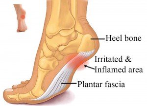 Plantar-Fasciitis[1][1]