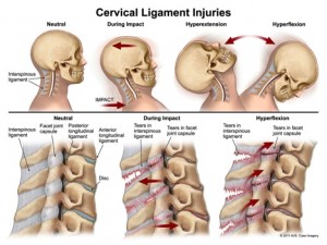 cervical-ligament-injuries