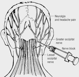 Occipitalis Zenuw, Hoofdpijn, Behandeling met Neuroprolotherapie