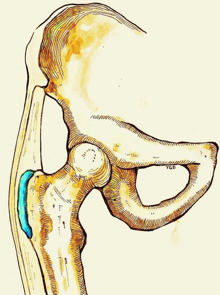 Slijmbeursonsteking Heup - Bursitis Trochanterica - Behandeling