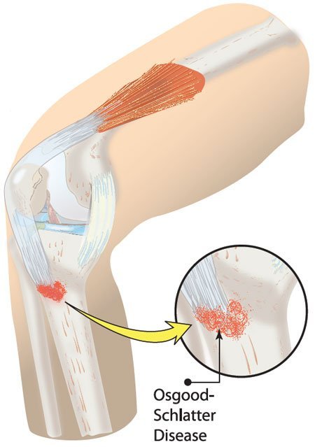 Osgood Schlatter